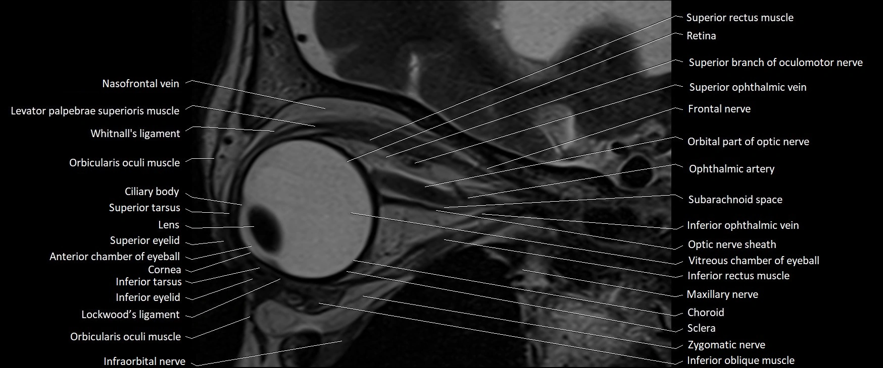 MRI Orbit sagittal cross sectional anatomy 3T image 10.webp